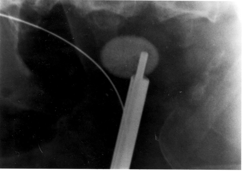Kidney Stone Image 4172-PH