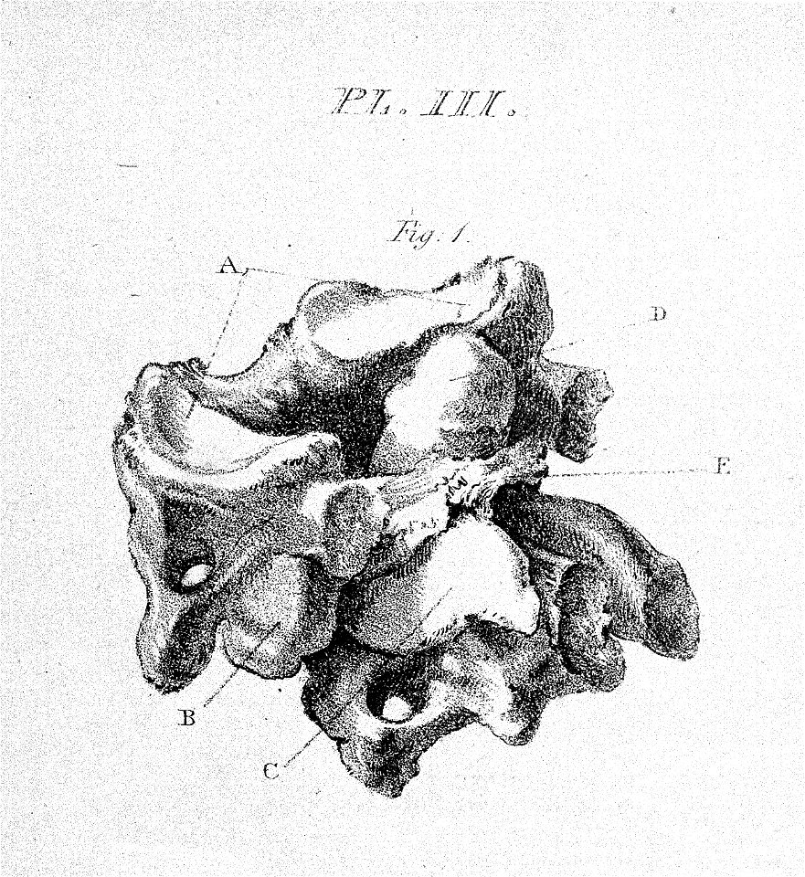 Luxation of the atlas Wellcome L0009924