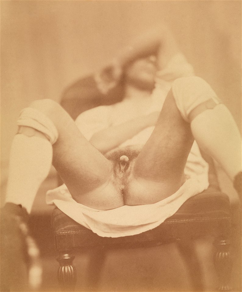 Photograph of hermaphrodite genetalia Crisco restoration