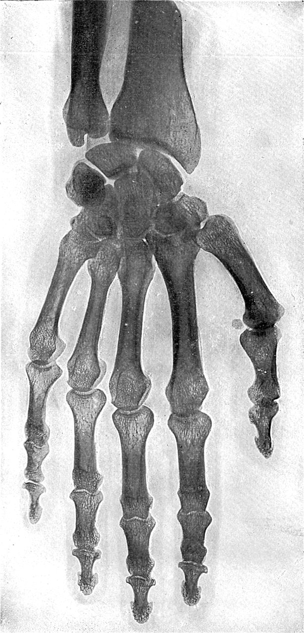 Radiograph of living hand (Rankin Kennedy, Electrical Installations, Vol V, 1903)