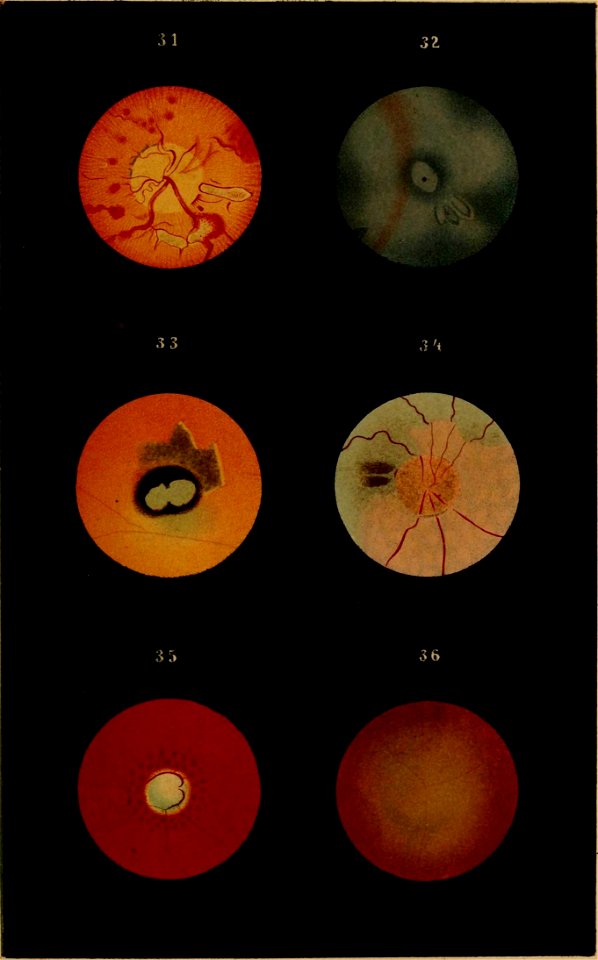 Plates illustrating the natural and morbid changes of the human eye pg 47