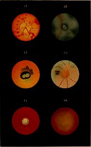 Plates illustrating the natural and morbid changes of the human eye pg 47