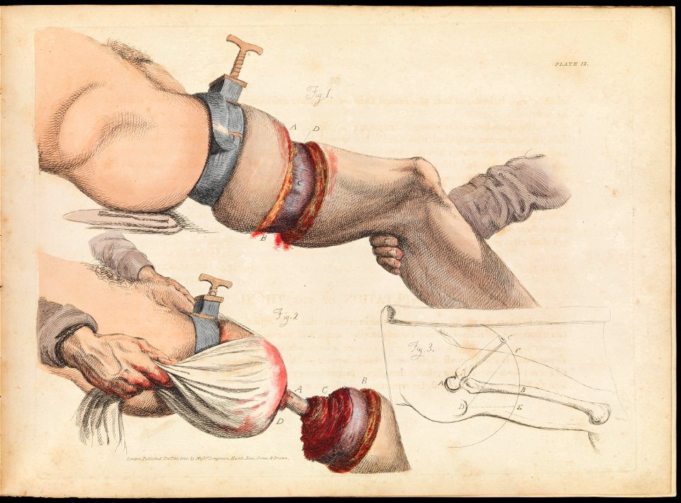 Plate IX, illustration of leg amputation, Sir Charles Bell Wellcome L0072192