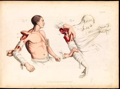 Plate XII, illustration of shoulder wound, Sir Charles Bell Wellcome L0072203