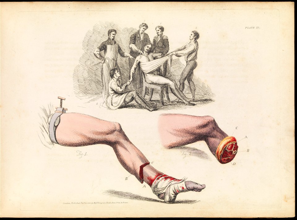 Plate XI, illustration of leg amputation, Sir Charles Bell Wellcome L0072193