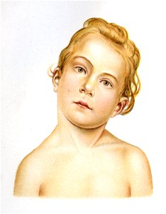 Siebert 22 - Torticolis