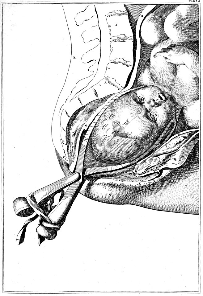 Smellie forceps