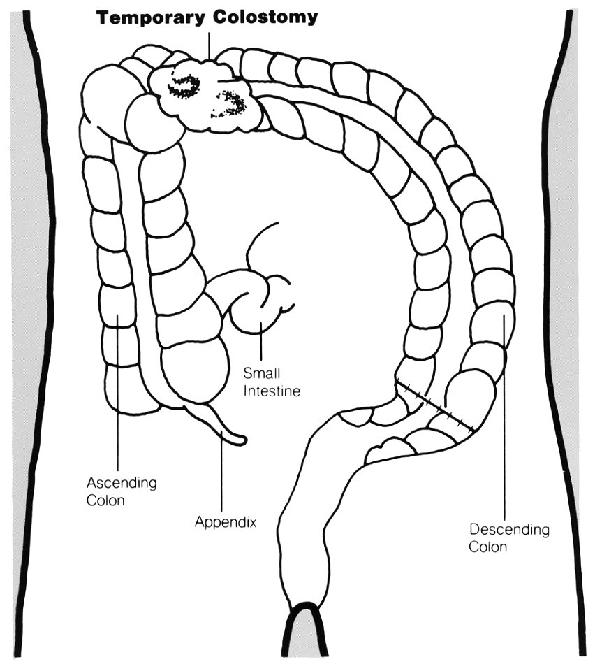 Temporary colostomy illustration