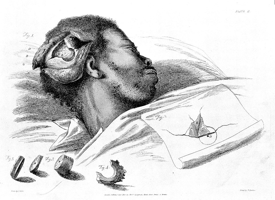 Trephination operation, 1821 Wellcome L0005059