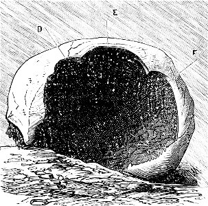 PSM V07 D626 Perforated cranium from lozere
