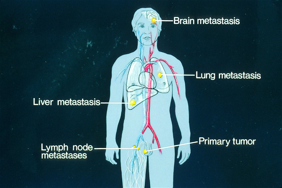 Sites of potential metastases illustration
