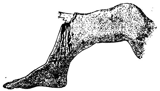 Grierson 35 Fractura expuesta de la tibia