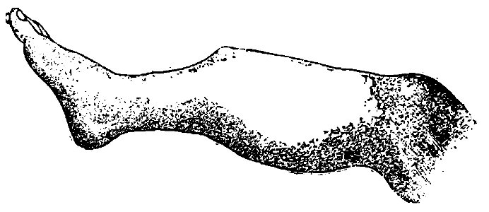 Grierson 34 Fractura simple de tibia
