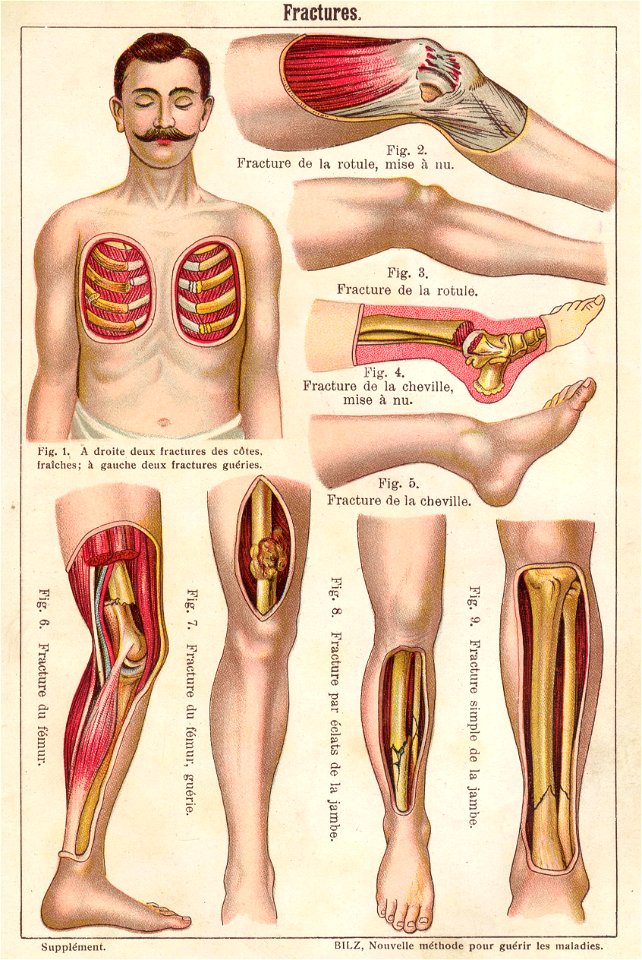 anatomie fractures 2