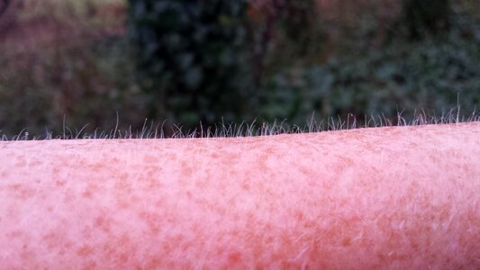 Goose bumps freckles cold