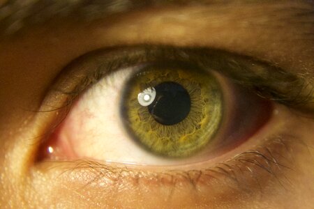 Iris tabs retina photo