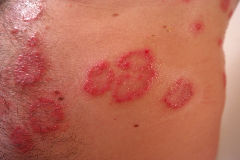 Reddish psoriasis skin disease