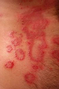 Reddish psoriasis skin disease photo