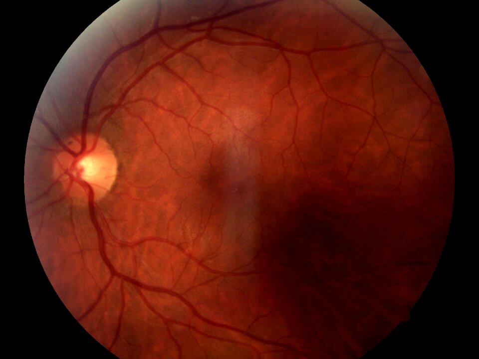 Eyeball medical nerve