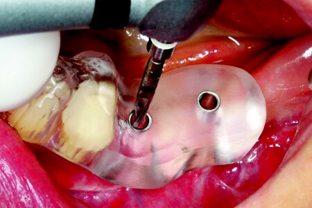 Cerec guide two