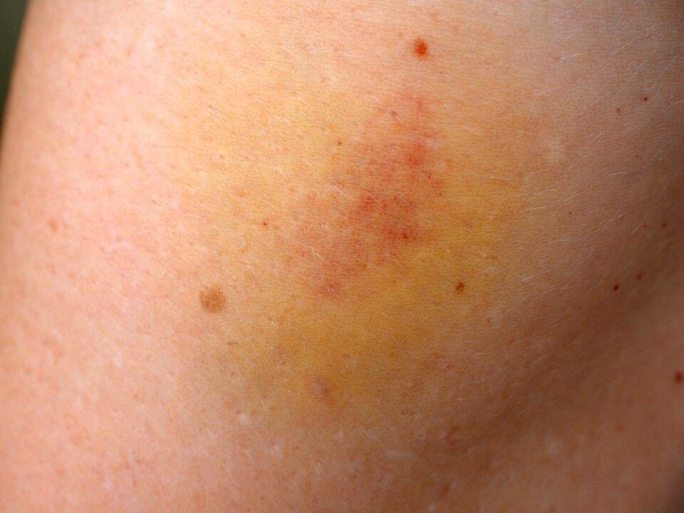 Haematoma discoloration skin