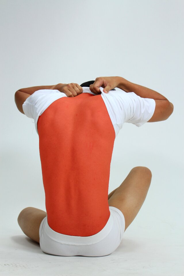 Burn red dermatology