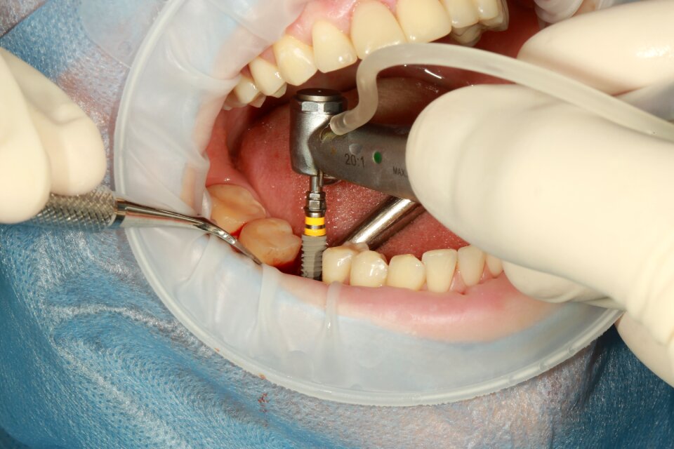 Dental implant surgery