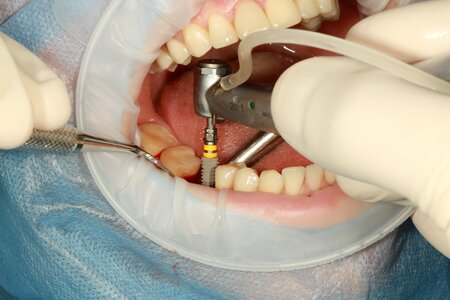 Dental implant surgery
