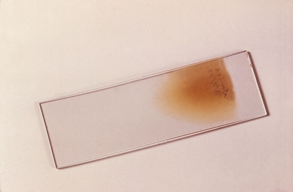 Alcohol blood methyl