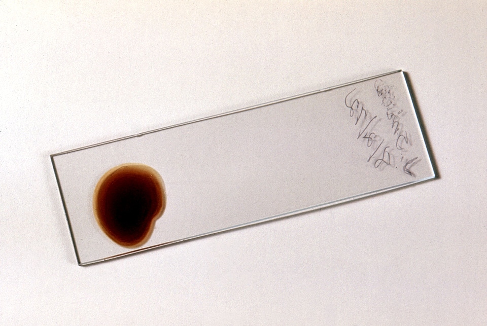 Appearance blood cervical smear