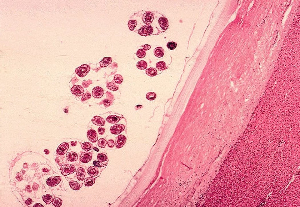 Cyst echinococcus histopathology photo