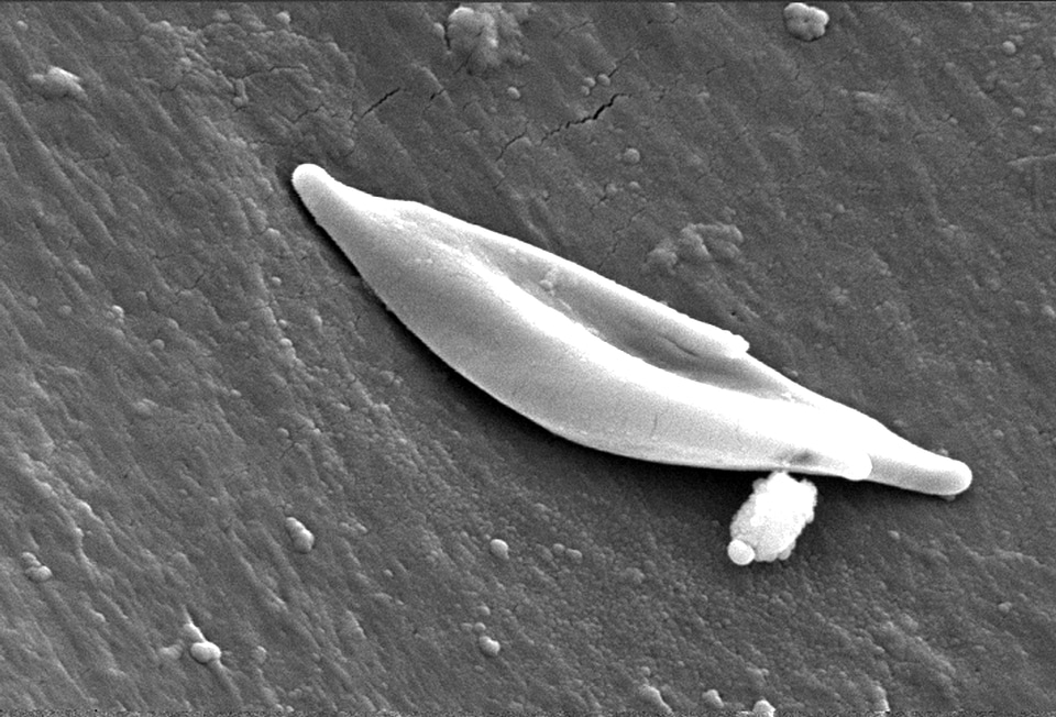 Blood cell disease