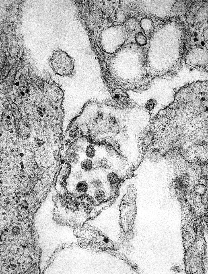 Coronavirus pneumonia COVID-19