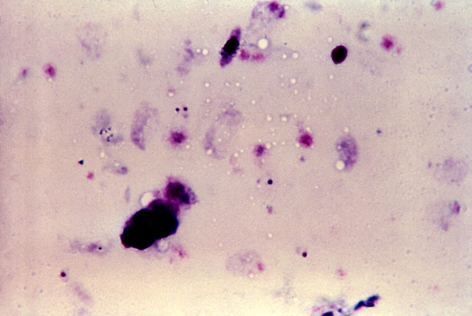 Blood cervical smear chromatin