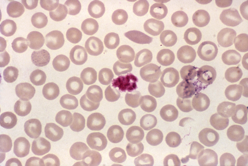 Blood cervical smear scrub
