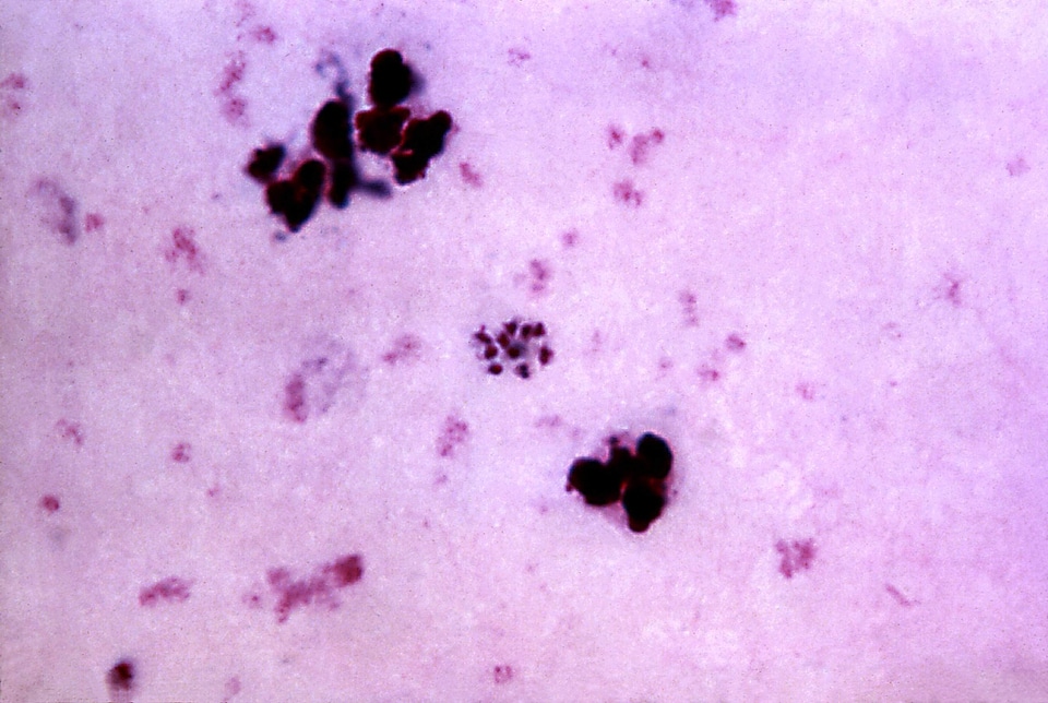 Blood cervical smear photomicrograph