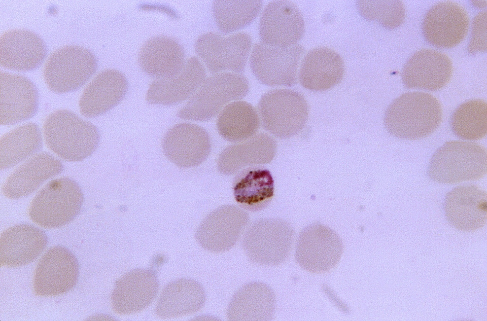 Band blood cervical smear