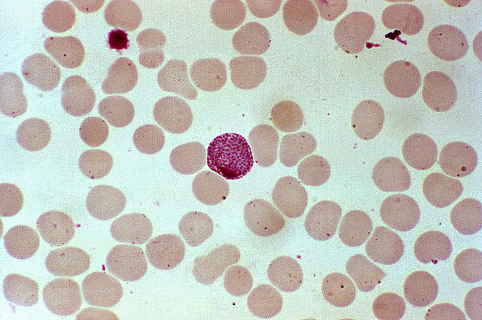 Blood cervical smear parasit