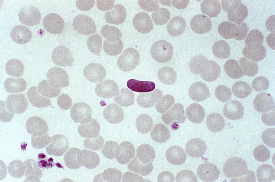 Blood cervical smear parasit