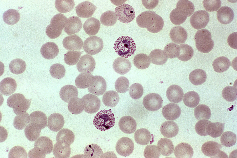 Blood cervical smear parasit