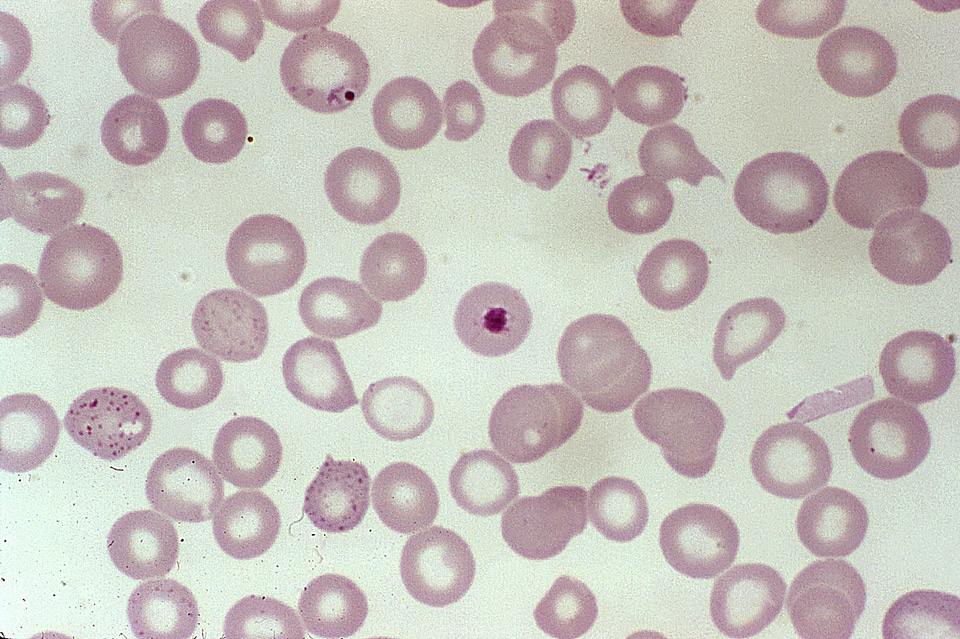 Blood cervical smear development