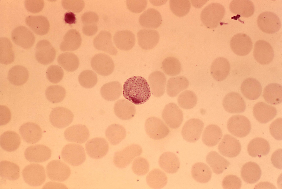 Blood cervical smear photomicrograph