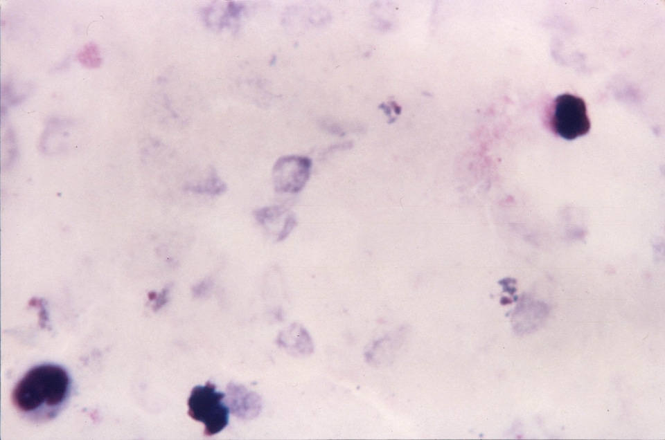 Crescent cytoplasm irregular