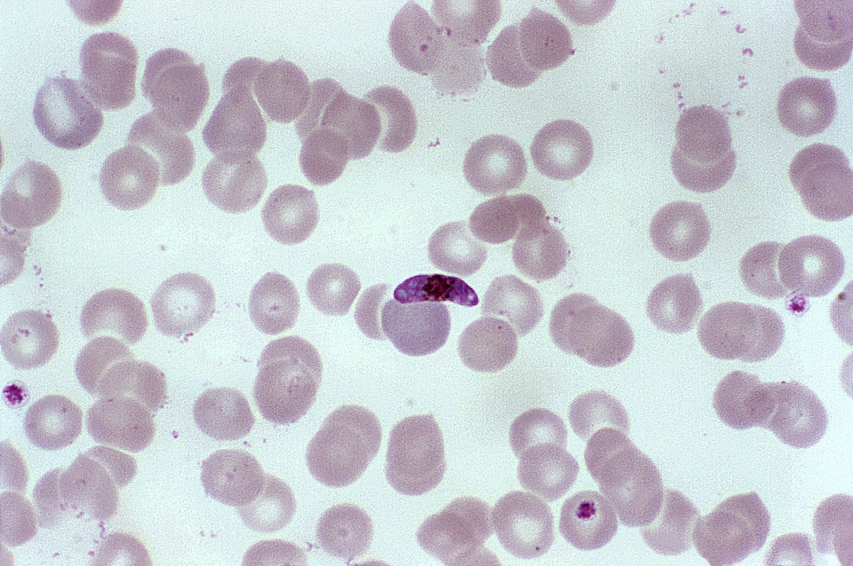 Blood cervical smear parasit