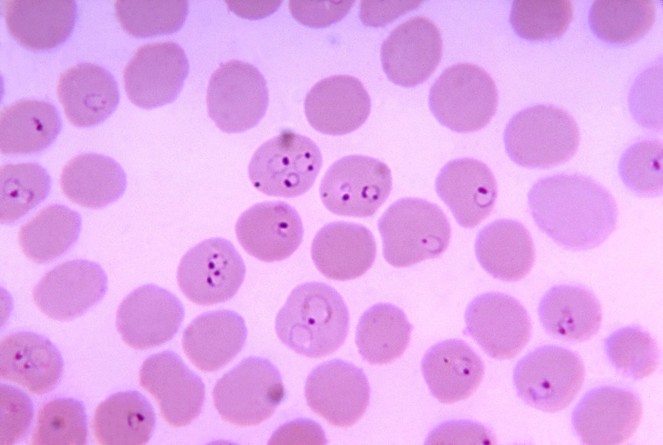 Blood cervical smear photomicrograph