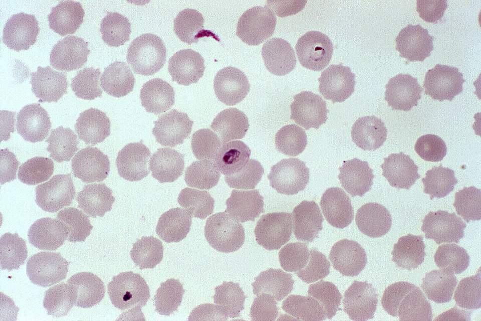 Blood cervical smear photomicrograph