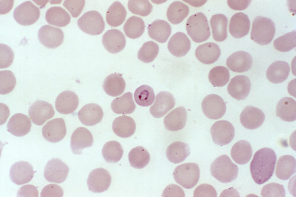 Blood cervical smear photomicrograph