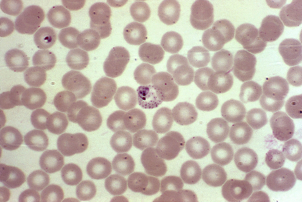 Blood cervical smear photomicrograph