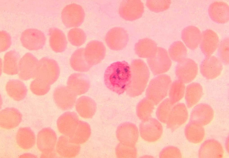 Blood cervical smear parasit