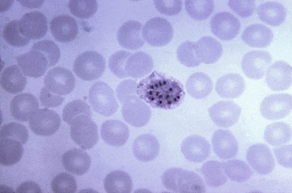 Blood cervical smear chromatin